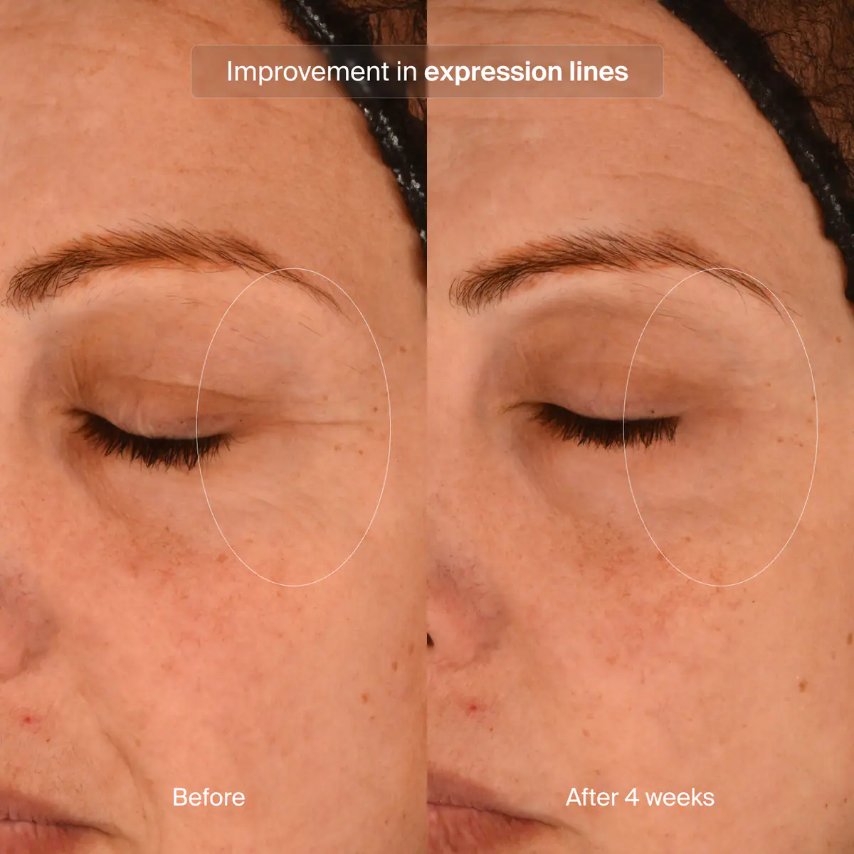 Before and after 4 weeks comparison of Pavise Precision Eye Lift use for improvement in expression lines.