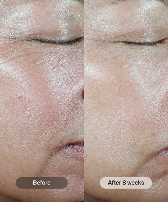 Before and after 8 weeks comparison of using Revision Skincare C+ Correcting Complex to brighten and even tone.