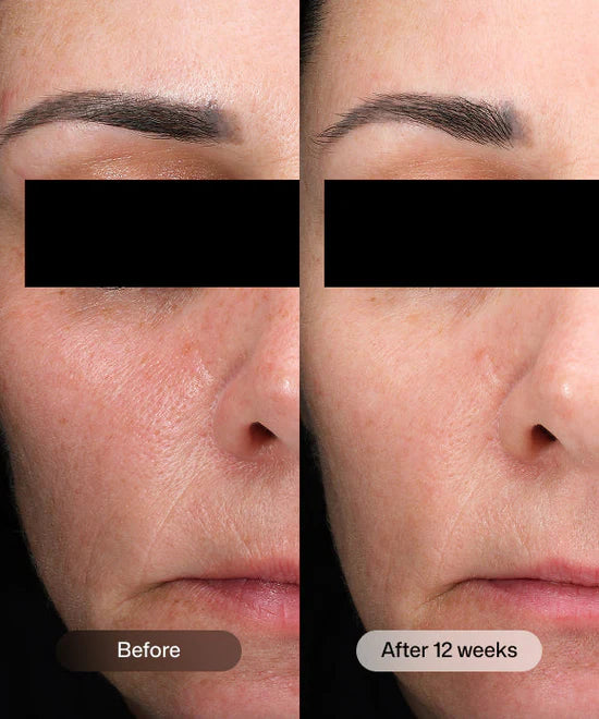 Before and after 12 weeks comparison of using Revision Skincare DEJ Daily Boosting Serum for energizing and longevity.
