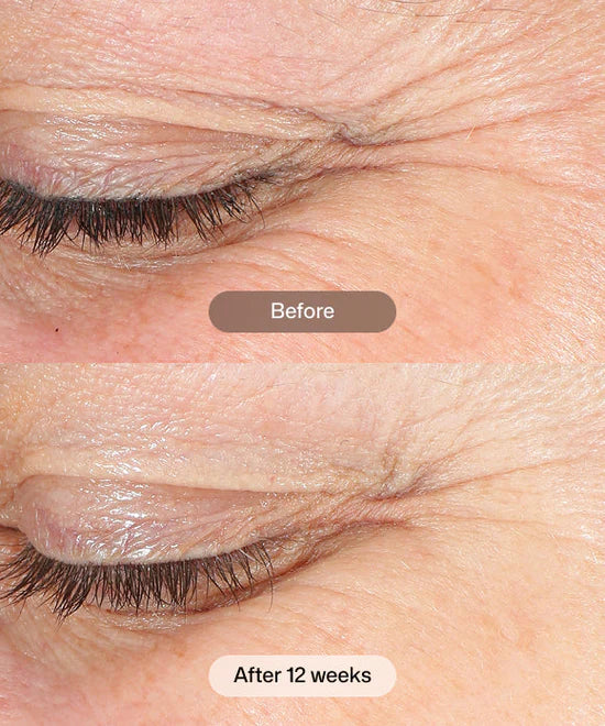 Before and after 12 weeks comparison of using Revision Skincare Revox Line Relaxer to visibly smooth expression lines.