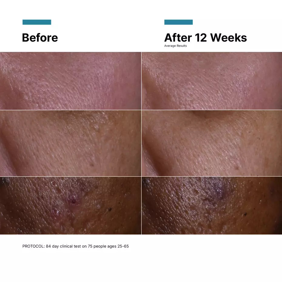 Before-and-after images showing visible skin improvement after 12 weeks of SkinCeuticals C E Ferulic use.