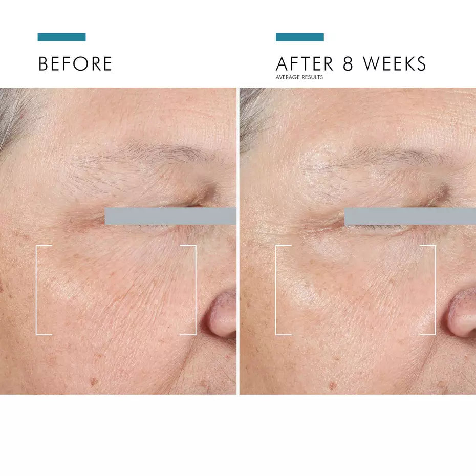 Before-and-after images showing visible eye-area improvement after 8 weeks of SkinCeuticals A.G.E. Advanced Eye use.