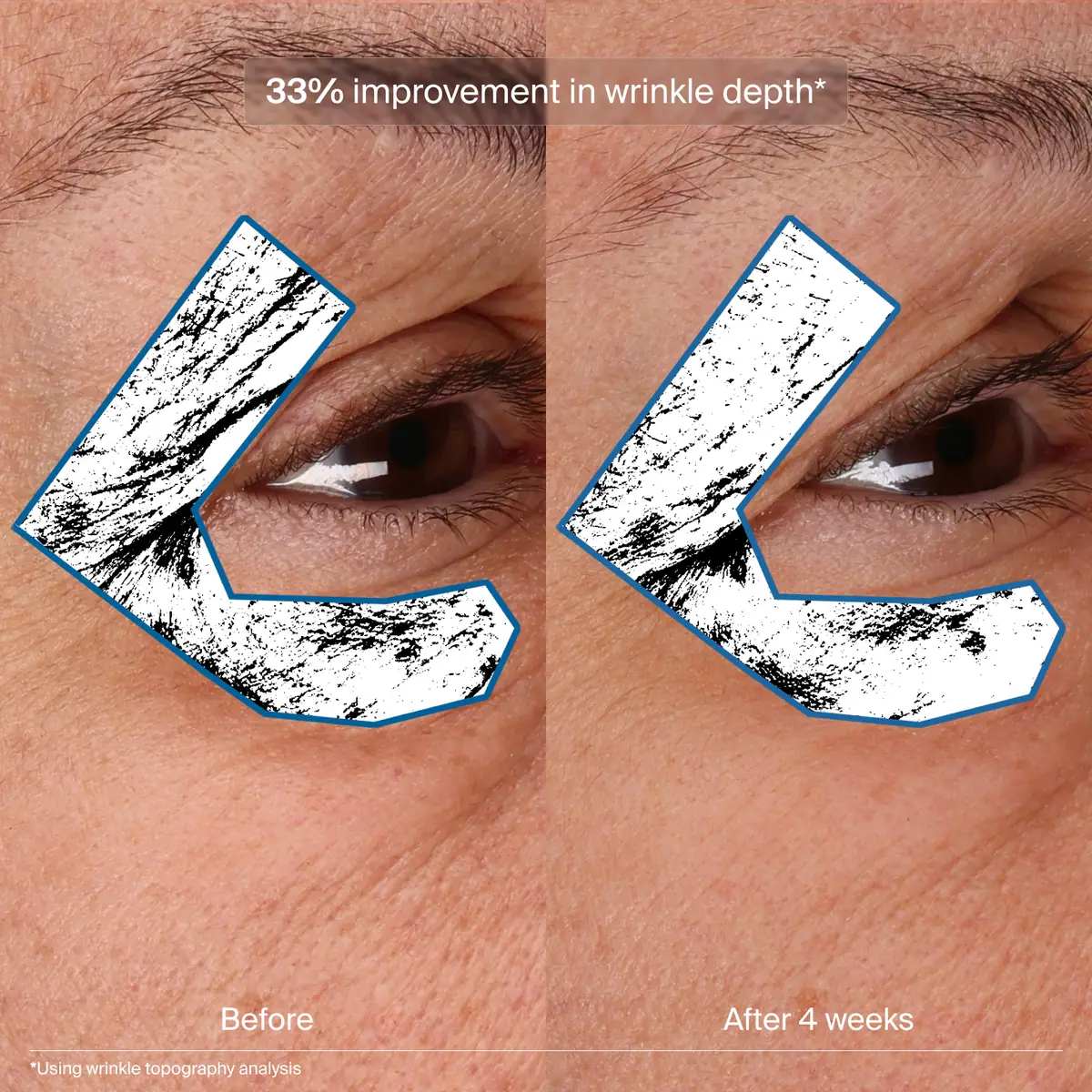 Before and after 4 weeks comparison of Pavise Bioadaptive Stress Repair use for 33% improvement in wrinkle depth. 