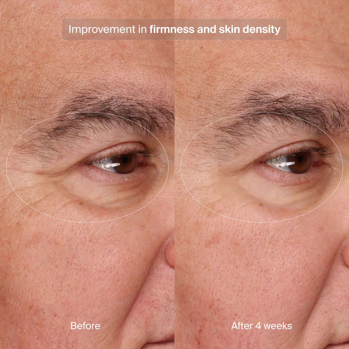 Before and after 4 weeks comparison of Pavise Precision Eye Lift use for improvement in firmness and skin density. 