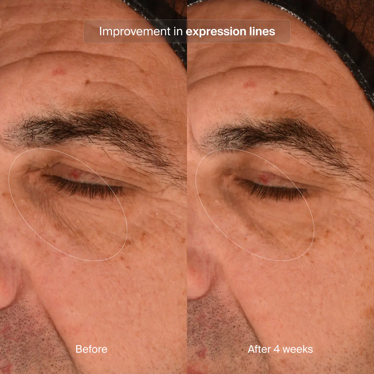 Before and after 4 weeks comparison of Pavise Precision Eye Lift use for improvement in expression lines. 