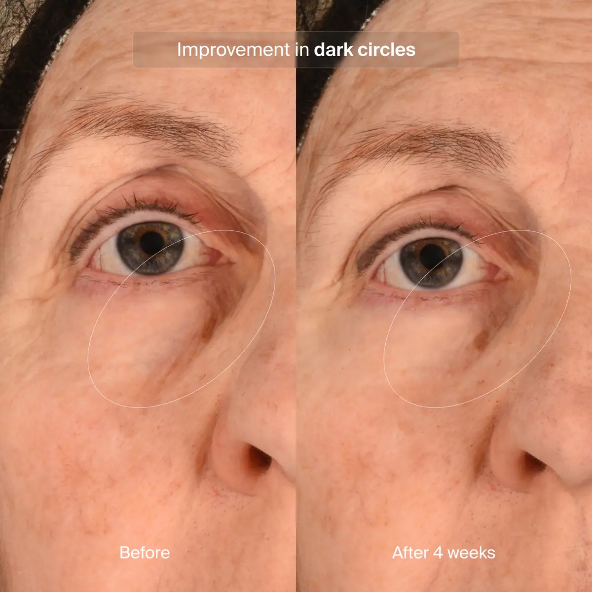 Before and after 4 weeks comparison of Pavise Precision Eye Lift use for improvement in dark circles. 