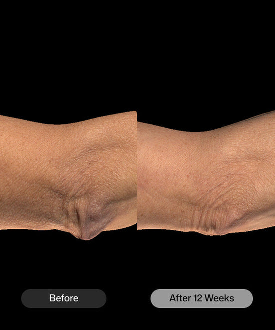 Before and after 12 weeks comparison of using Revision Skincare BodiContour sculpting cream on elbow for clinically proven body firming. 
