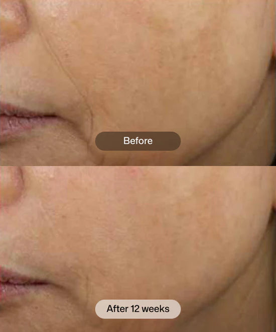 Before and after 12 weeks comparison of Revision Skincare DEJ Face Cream multi-pathway moisturizer. 